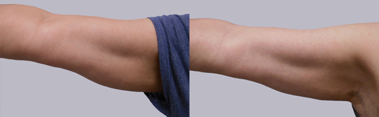 Vorher-Nachher Kryolipolyse Arm Vorher-Nachher Kryolipolyse Arm